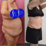 Liposuction Abdomen Plus Size Before & After Patient #13515