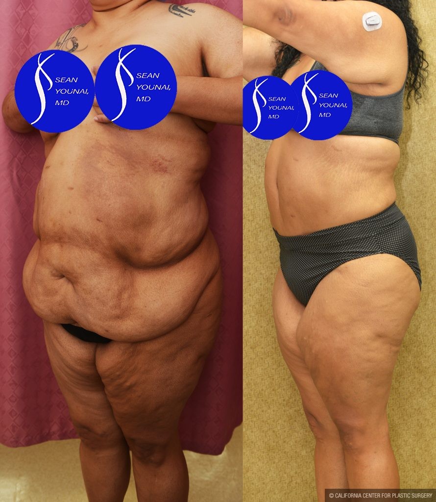 Tummy Tuck (Abdominoplasty) Super Plus Size Before & After Patient #13516