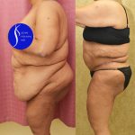 Tummy Tuck (Abdominoplasty) Super Plus Size Before & After Patient #13517