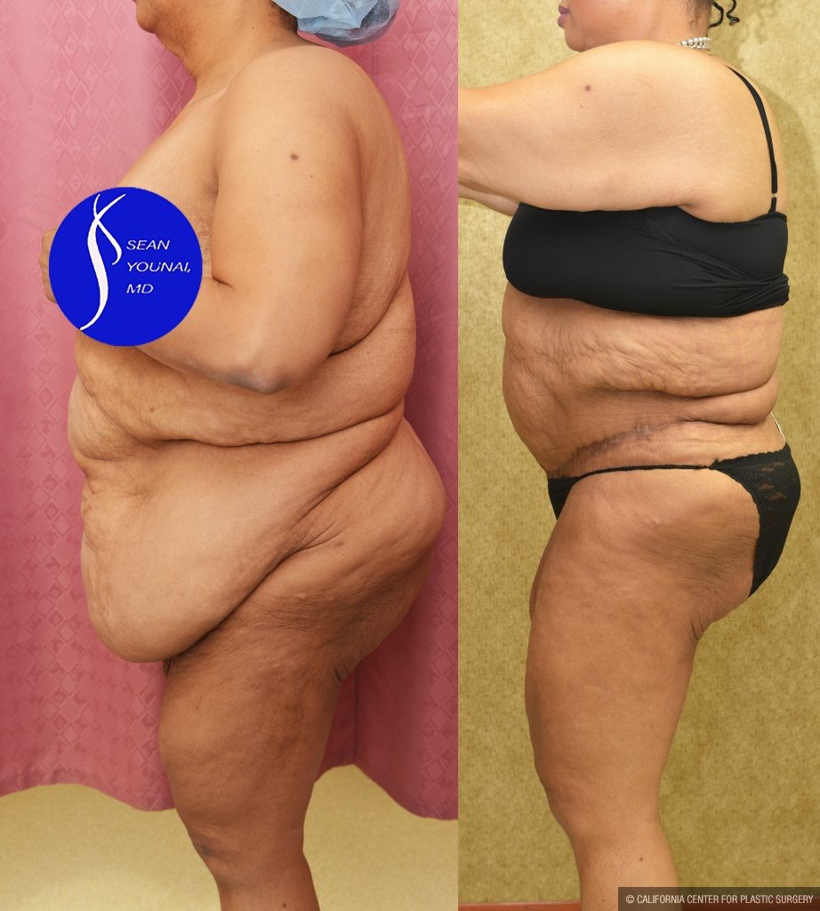 Tummy Tuck (Abdominoplasty) Super Plus Size Before & After Patient #13517