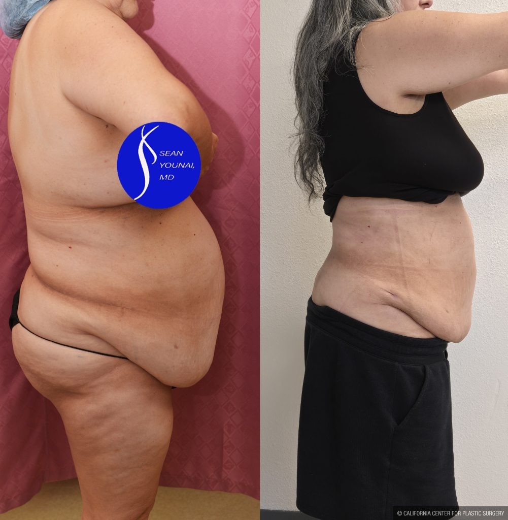 Liposuction Abdomen Plus Size Before & After Patient #13515