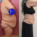 Liposuction Abdomen Plus Size Before & After Patient #13515