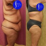 Tummy Tuck (Abdominoplasty) Super Plus Size Before & After Patient #13516