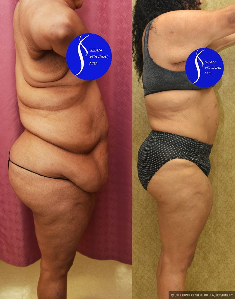 Tummy Tuck (Abdominoplasty) Super Plus Size Before & After Patient #13516