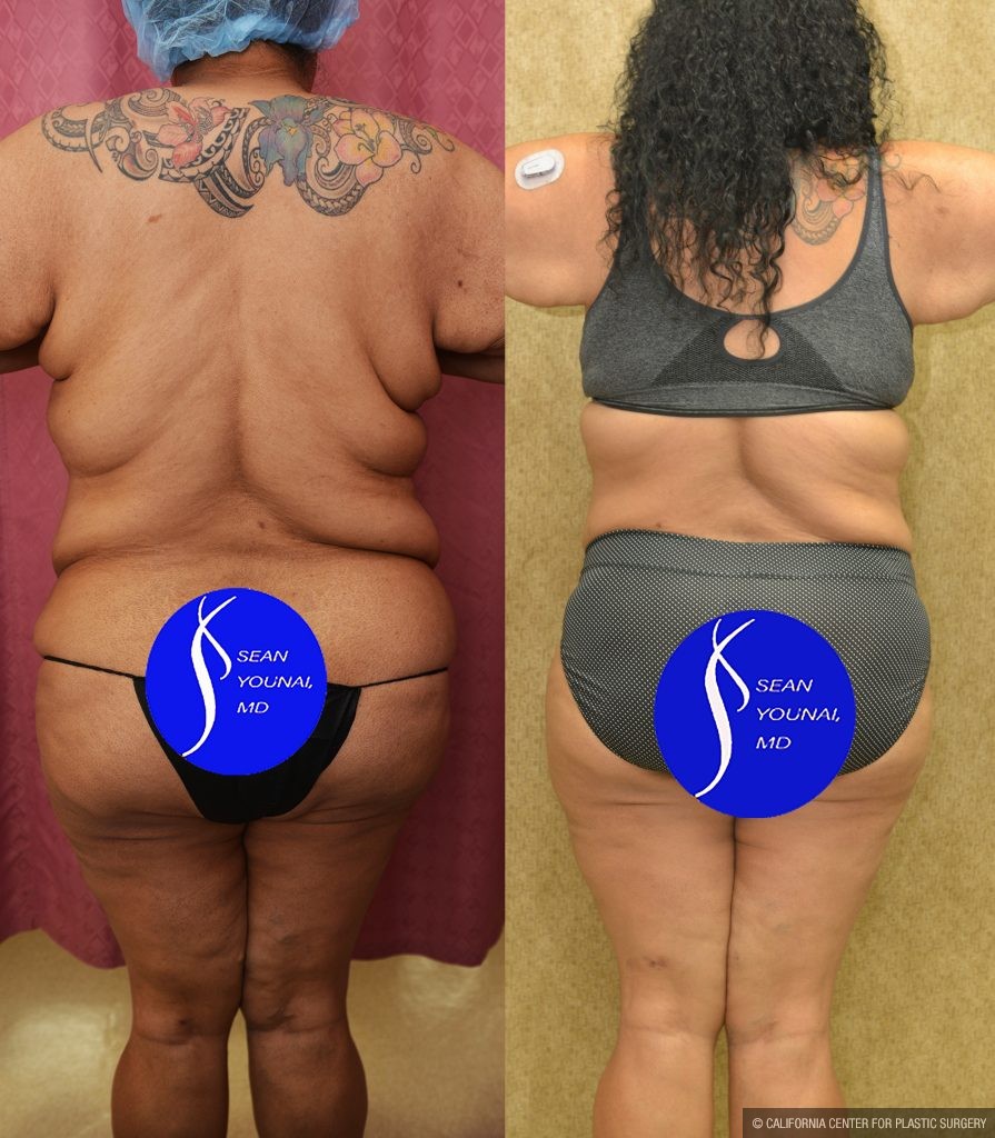 Tummy Tuck (Abdominoplasty) Super Plus Size Before & After Patient #13516