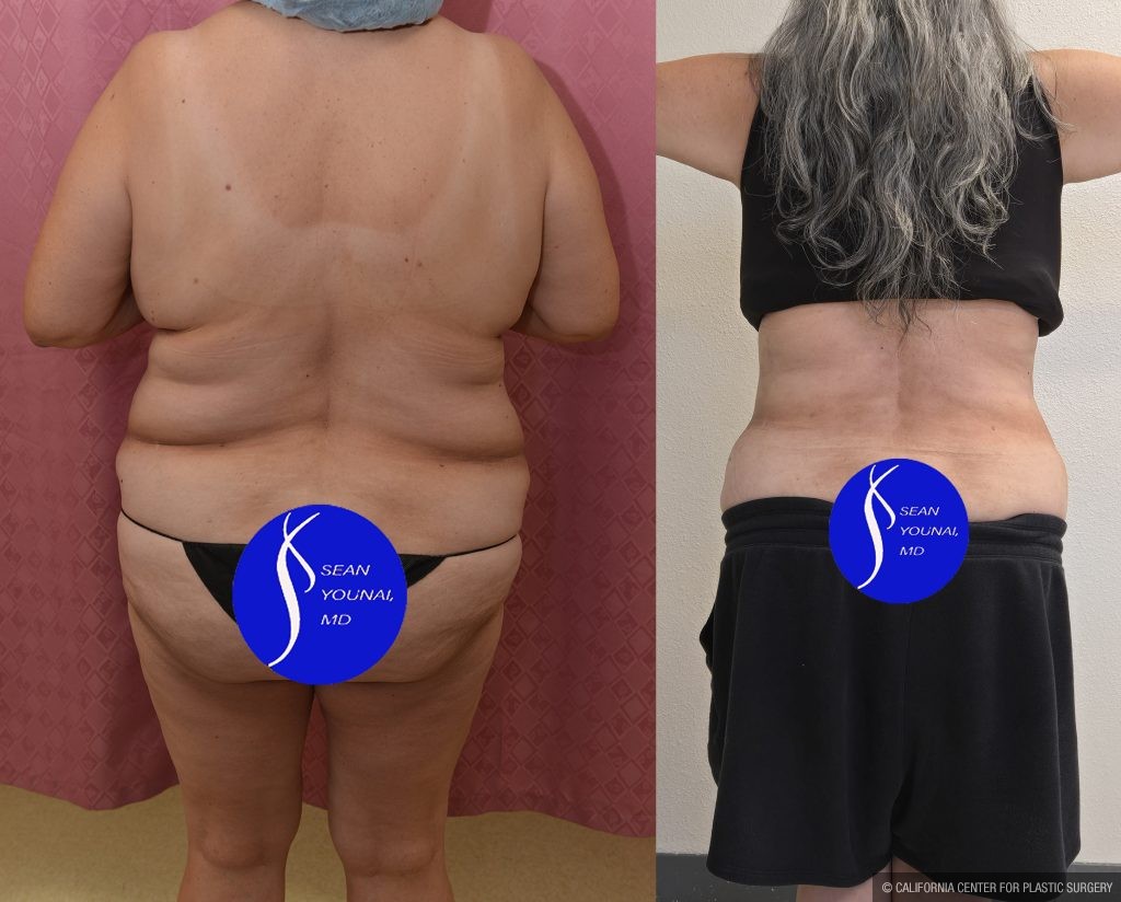 Liposuction Abdomen Plus Size Before & After Patient #13515