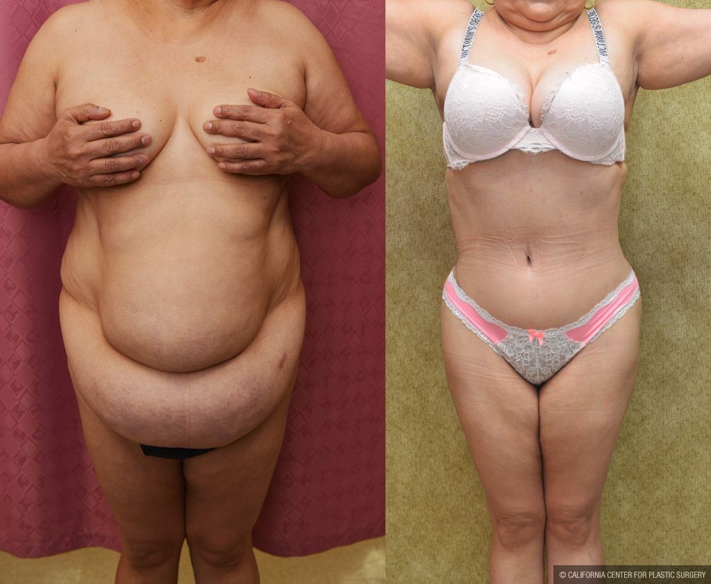 Tummy Tuck (Abdominoplasty) Super Plus Size Before & After Patient #13545