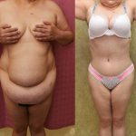 Tummy Tuck (Abdominoplasty) Super Plus Size Before & After Patient #13545