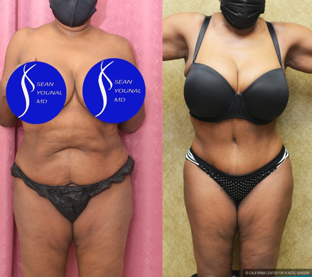 African American Tummy Tuck (Abdominoplasty) Before & After Patient #13556