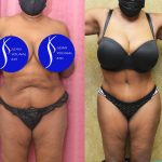 African American Tummy Tuck (Abdominoplasty) Before & After Patient #13556