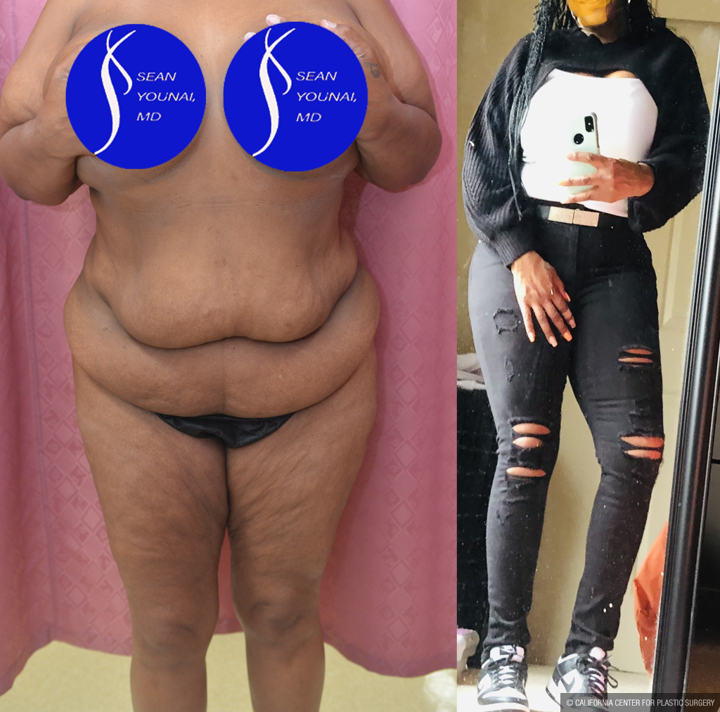 Tummy Tuck (Abdominoplasty) Plus Size Before & After Patient #13546