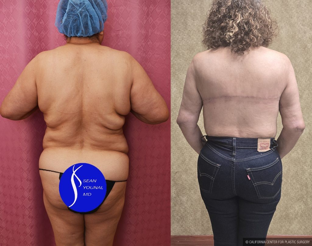 Upper Back Lift Before & After Patient #13544