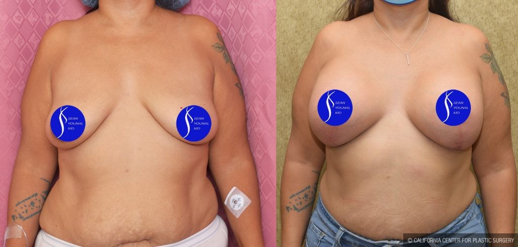 Breast Lift - Full Before & After Patient #13557