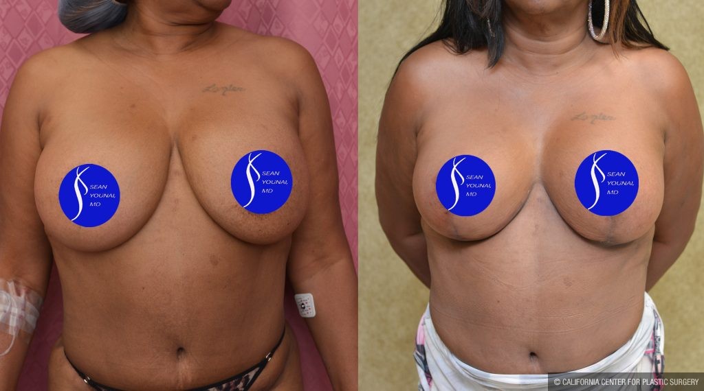 Breast Lift - Full Before & After Patient #13558