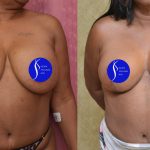Breast Lift - Full Before & After Patient #13558