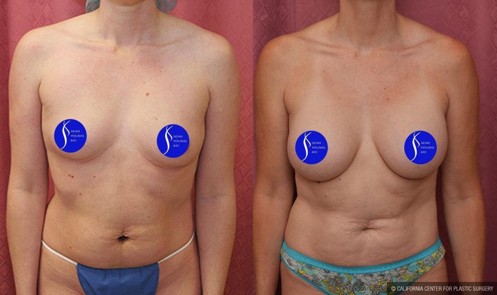 Breast Augmentation Before & After Patient #13559
