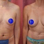 Breast Augmentation Before & After Patient #13559