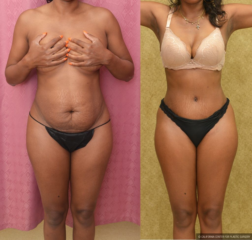 Tummy Tuck (Abdominoplasty) Small Size Before & After Patient #13560