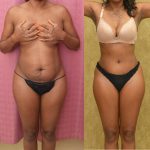 Tummy Tuck (Abdominoplasty) Small Size Before & After Patient #13560
