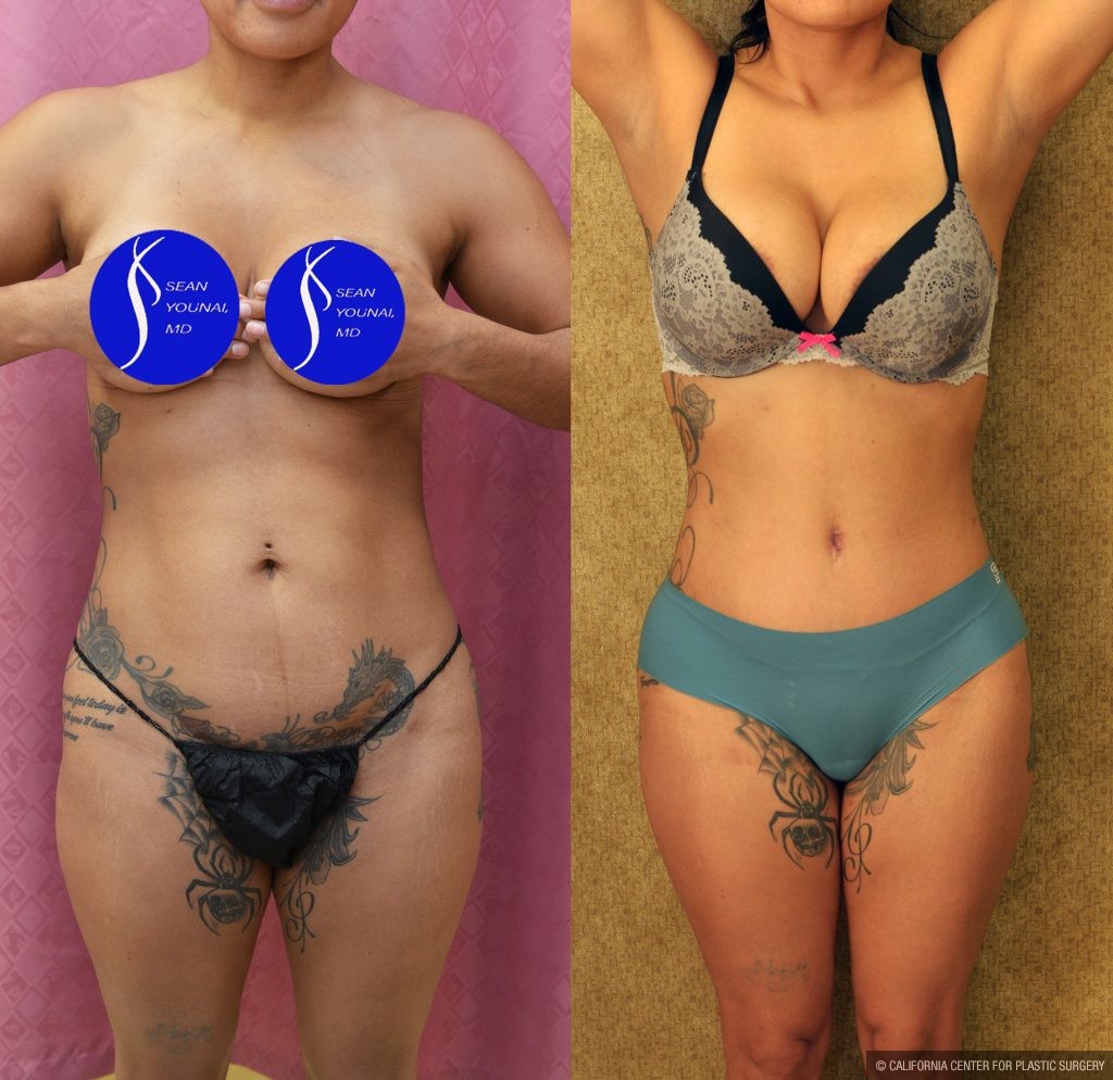 Tummy Tuck (Abdominoplasty) Small Size Before & After Patient #13561