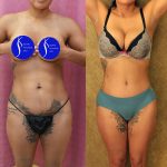 Tummy Tuck (Abdominoplasty) Small Size Before & After Patient #13561