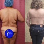 Upper Back Lift Before & After Patient #13544