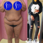Tummy Tuck (Abdominoplasty) Plus Size Before & After Patient #13546