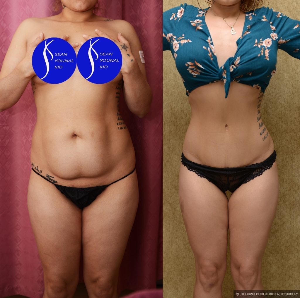 Tummy Tuck (Abdominoplasty) Small Size Before & After Patient #13562