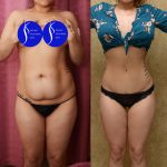 Tummy Tuck (Abdominoplasty) Small Size Before & After Patient #13562