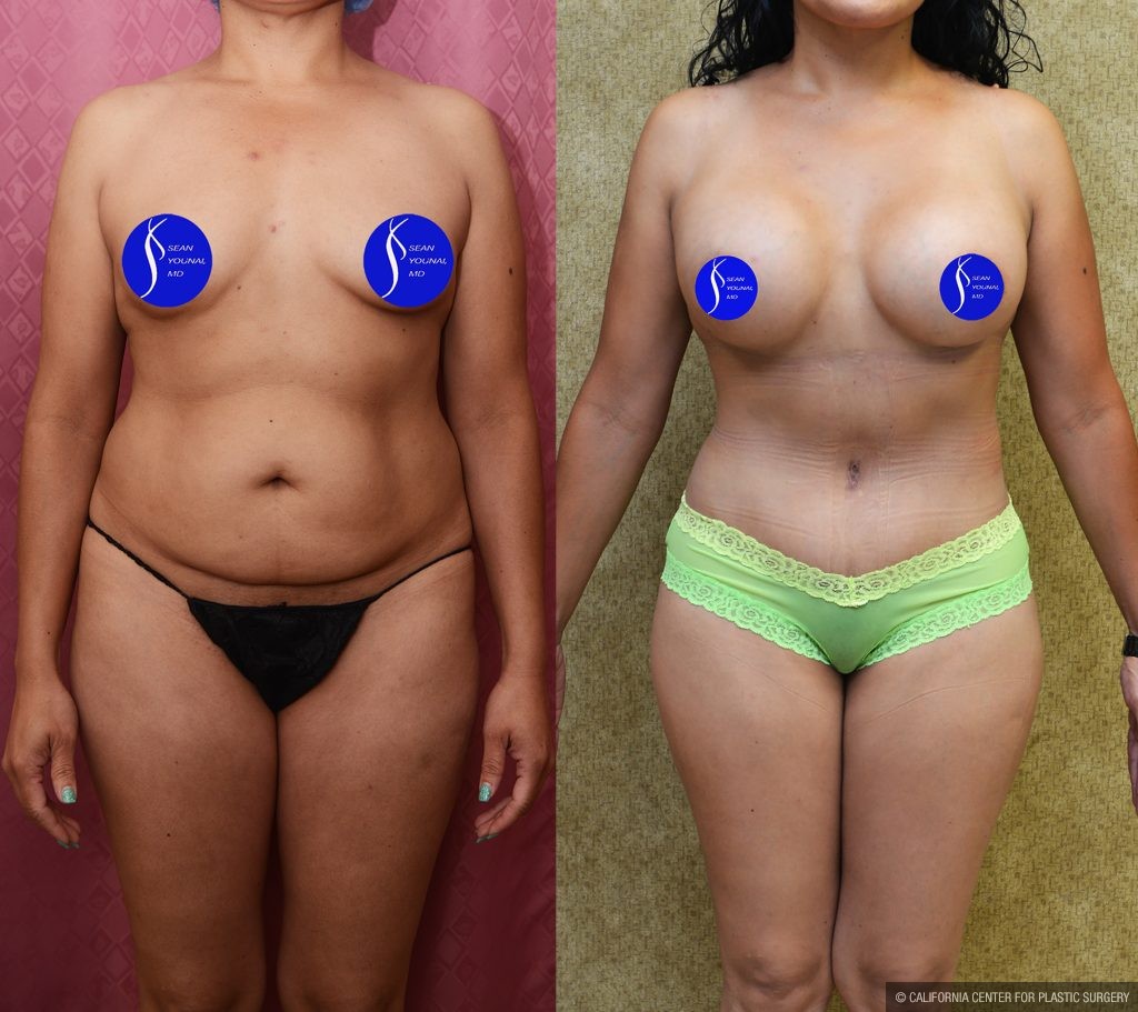Mommy Makeover Before & After Patient #13563