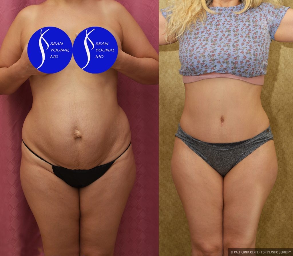 Tummy Tuck (Abdominoplasty) Small Size Before & After Patient #13549