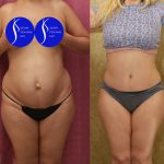 Tummy Tuck (Abdominoplasty) Small Size Before & After Patient #13549