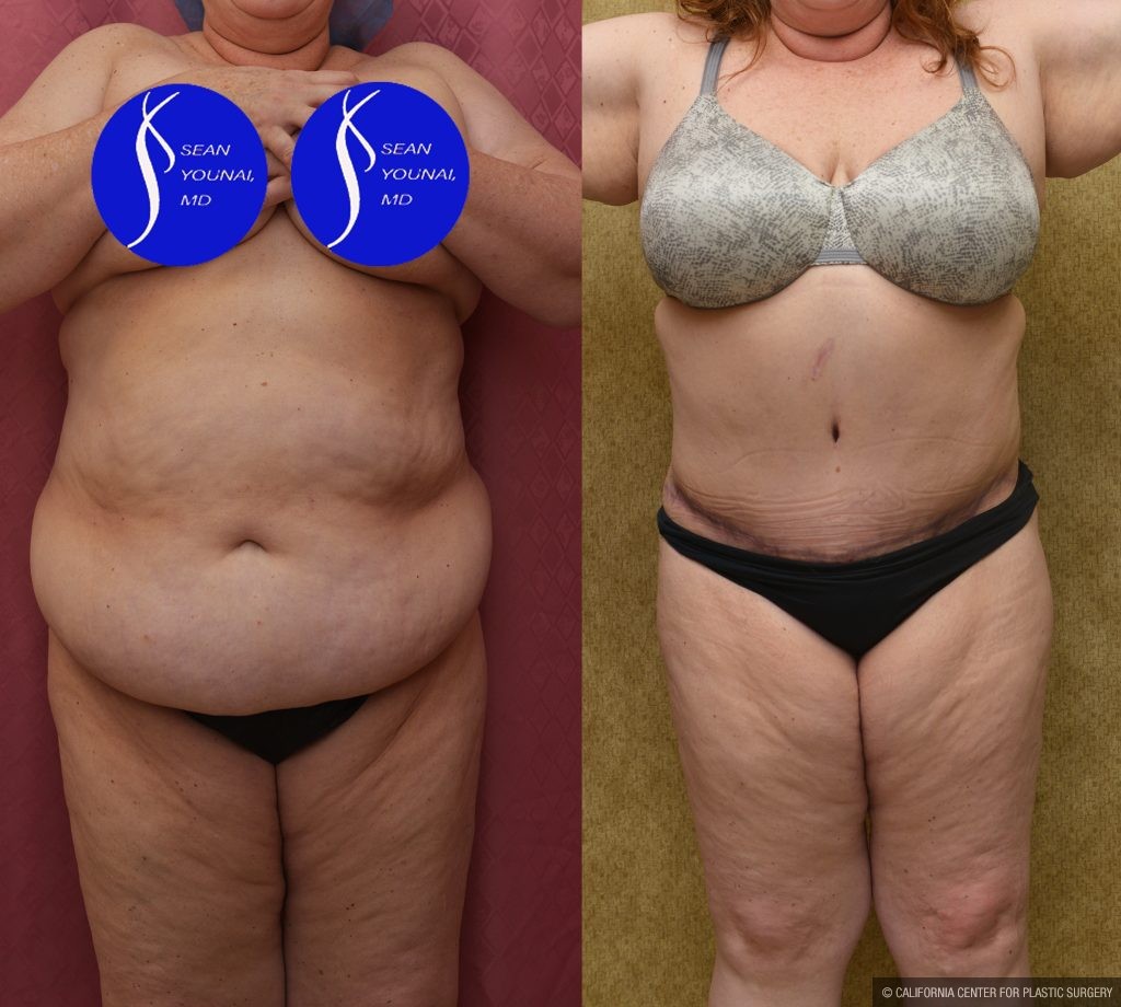Tummy Tuck (Abdominoplasty) Plus Size Before & After Patient #13550