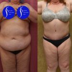 Tummy Tuck (Abdominoplasty) Plus Size Before & After Patient #13550