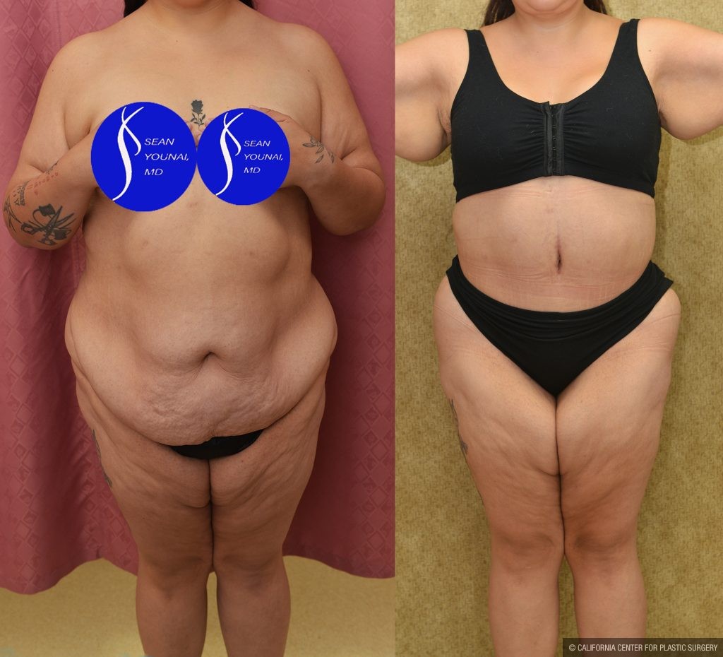 Tummy Tuck (Abdominoplasty) Plus Size Before & After Patient #13552