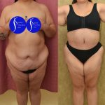 Tummy Tuck (Abdominoplasty) Plus Size Before & After Patient #13552