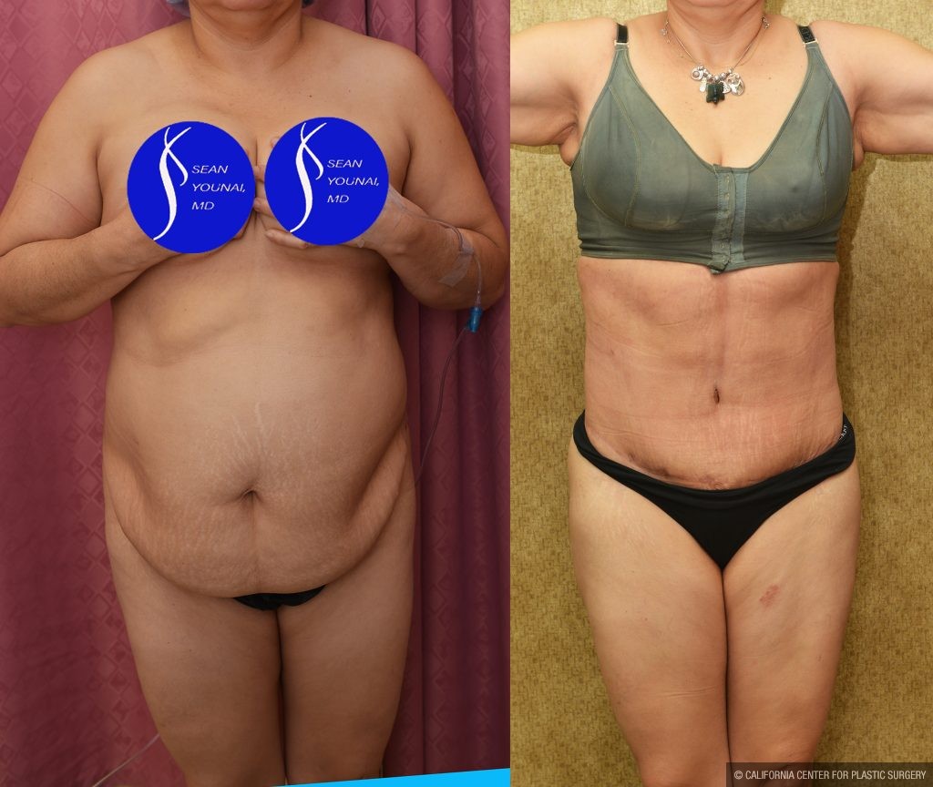 Tummy Tuck (Abdominoplasty) Medium Size Before & After Patient #13553