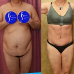 Tummy Tuck (Abdominoplasty) Medium Size Before & After Patient #13553