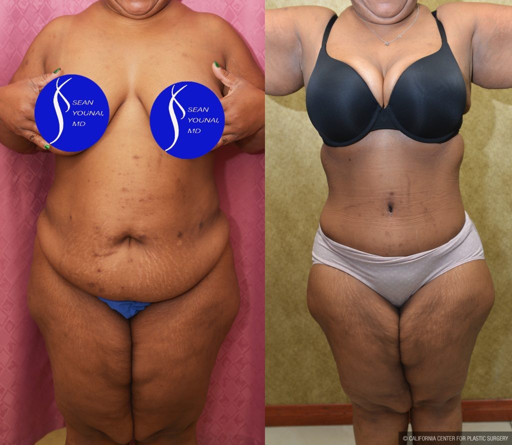 Tummy Tuck (Abdominoplasty) Plus Size Before & After Patient #13554