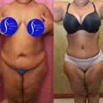 Tummy Tuck (Abdominoplasty) Plus Size Before & After Patient #13554