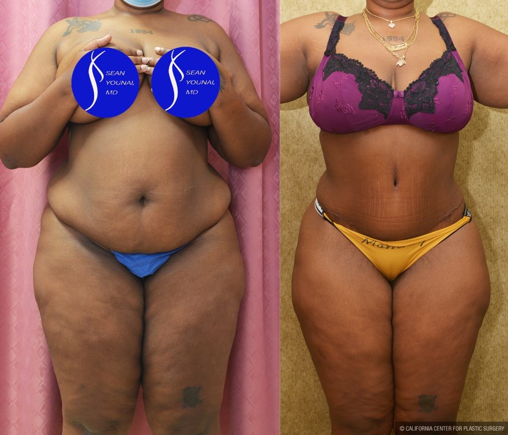 African American Tummy Tuck (Abdominoplasty) Before & After Patient #13555