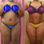 African American Tummy Tuck (Abdominoplasty) Before & After Patient #13555