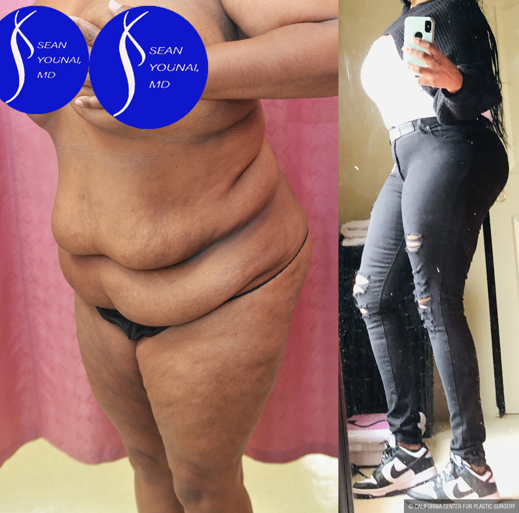 Tummy Tuck (Abdominoplasty) Plus Size Before & After Patient #13546
