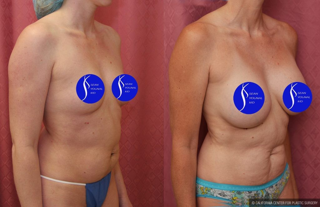 Breast Augmentation Before & After Patient #13559