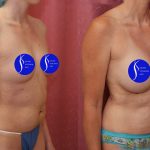 Breast Augmentation Before & After Patient #13559