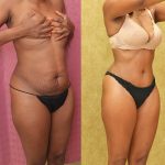 Tummy Tuck (Abdominoplasty) Small Size Before & After Patient #13560