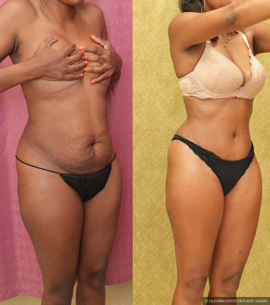 Tummy Tuck (Abdominoplasty) Small Size Before & After Patient #13560