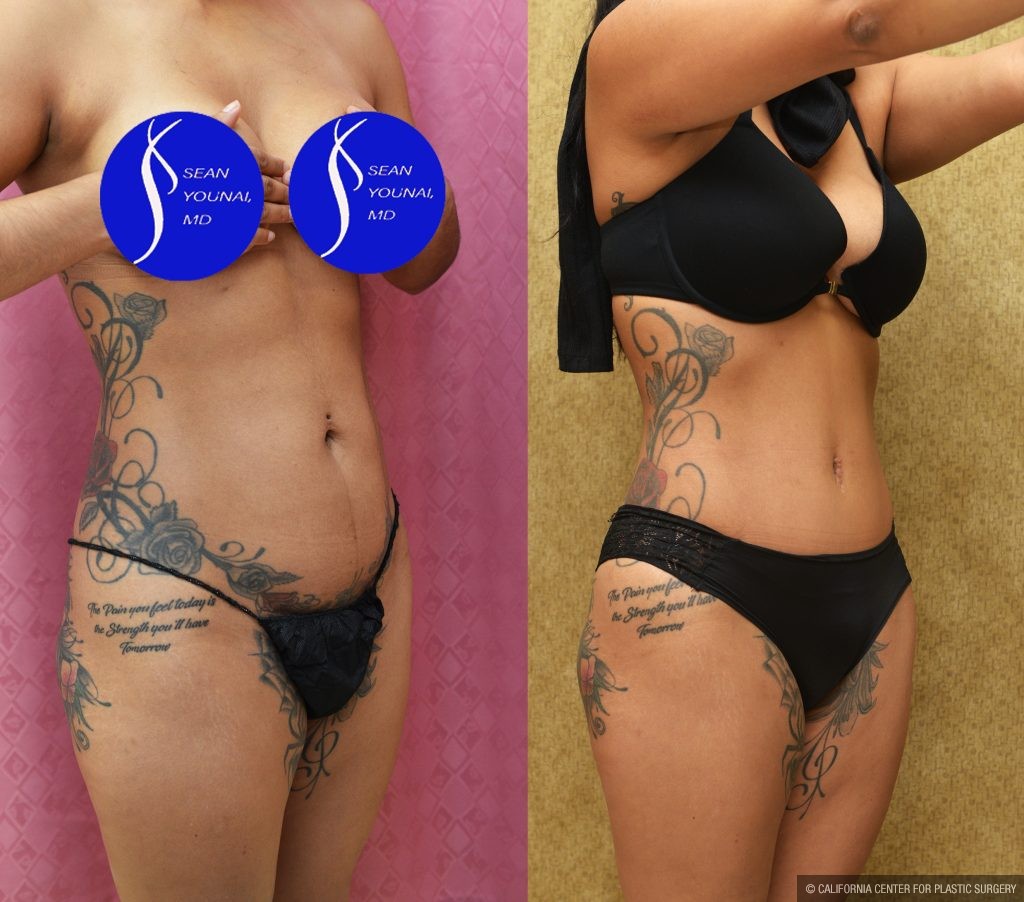Tummy Tuck (Abdominoplasty) Small Size Before & After Patient #13561