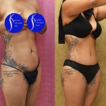 Tummy Tuck (Abdominoplasty) Small Size Before & After Patient #13561