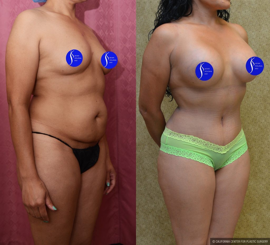 Mommy Makeover Before & After Patient #13563